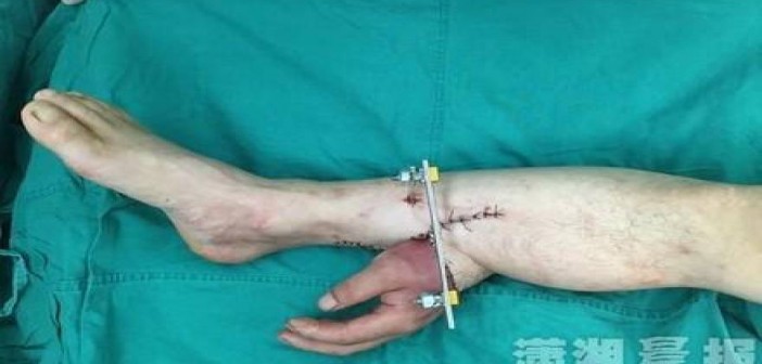 Του έραψαν το χέρι στο πόδι για να το κρατήσουν ζωντανό