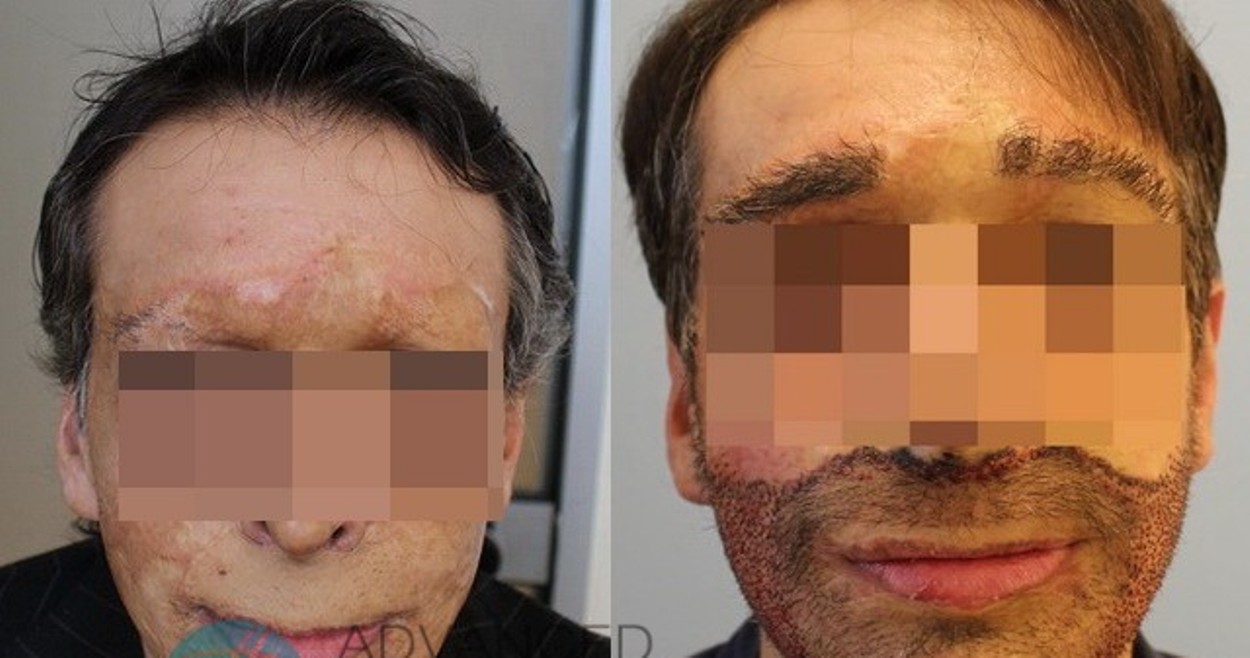 Νέο πρόσωπο σε 34χρονο δημιούργησαν Έλληνες επιστήμονες