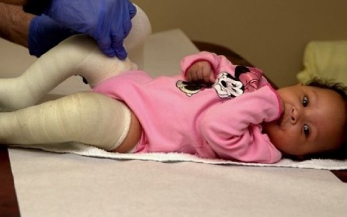 Νόσος Legg-Calve-Perthes: Τι είναι και πότε εμφανίζεται στα παιδιά