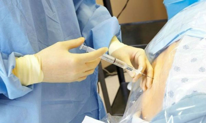 Επισκληρίδιος αναλγησία: ‘Οσα πρέπει αν ξέρετε