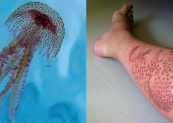 Τσίμπημα από τσούχτρα: Πως φεύγει ο πόνος – Τι να κάνετε αμέσως