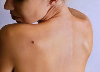 Εξαφανίστε τις κρεατοελιές με χυμό λεμονιού – Σίγουρα δεν γνωρίζετε αυτά τα 3 κόλπα
