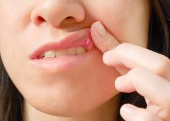 Τι να κάνετε για τις άφθες στο στόμα – Γιατί εμφανίζονται εξαρχής