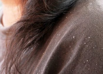 Πώς θα ξέρετε αν έχετε πιτυρίδα ή ξηροδερμία και πώς θα απαλλαγείτε με φυσικούς τρόπους