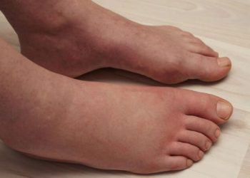 Πρησμένα πόδια: 5 πιθανές αιτίες που πρέπει να γνωρίζετε