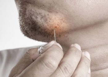 Τι να κάνεις για τις τρίχες που «γυρίζουν προς τα μέσα» και δημιουργούν σπυράκια