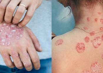 Ψωρίαση τον χειμώνα: 4 tips για ένα υγιέστερο ανοσοποιητικό σύστημα