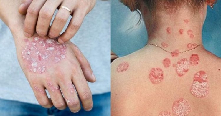 Ψωρίαση τον χειμώνα: 4 tips για ένα υγιέστερο ανοσοποιητικό σύστημα
