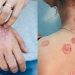 Ψωρίαση τον χειμώνα: 4 tips για ένα υγιέστερο ανοσοποιητικό σύστημα