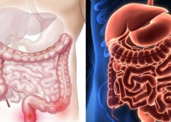 Νόσος του Crohn: Οι μύκητες που επιδεινώνουν τα συμπτώματα της νόσου