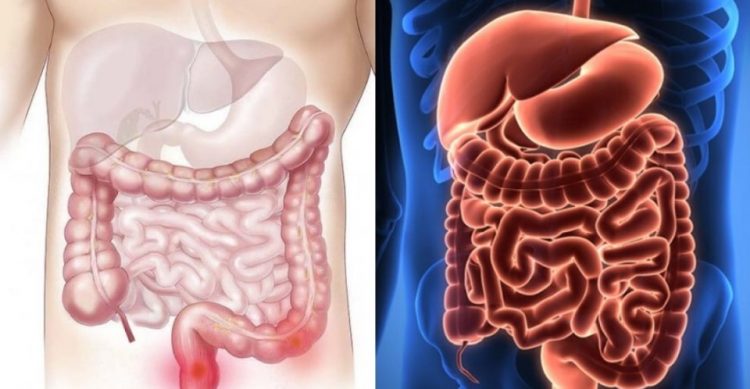 Νόσος του Crohn: Οι μύκητες που επιδεινώνουν τα συμπτώματα της νόσου