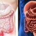 Νόσος του Crohn: Οι μύκητες που επιδεινώνουν τα συμπτώματα της νόσου