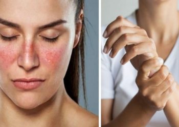 Έπεφταν ακατάσχετα τα μαλλιά και τα φρύδια μου – Η σκληρή μου μάχη με τον Λύκο