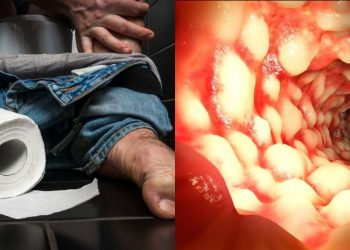 Νόσος του Crohn: Ποια είναι τα 5 συμπτώματα που πρέπει να προσέξετε
