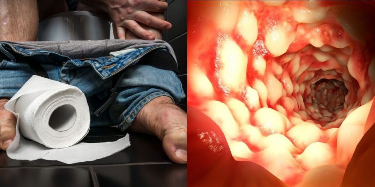 Νόσος του Crohn: Ποια είναι τα 5 συμπτώματα που πρέπει να προσέξετε