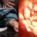Νόσος του Crohn: Ποια είναι τα 5 συμπτώματα που πρέπει να προσέξετε