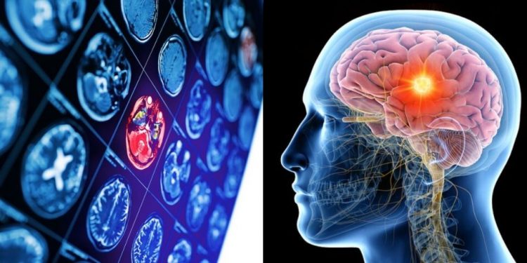 Όγκος στον εγκέφαλο: 6 σημεία-κλειδιά που πρέπει να γνωρίζετε πριν να είναι αργά