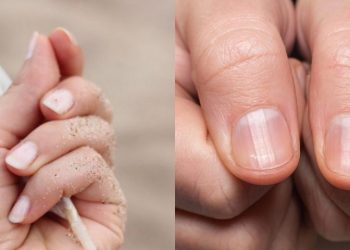 Τα σημάδια στα νύχια που μαρτυρούν ότι έχετε περάσει κορωνοϊό