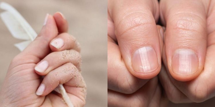 Τα σημάδια στα νύχια που μαρτυρούν ότι έχετε περάσει κορωνοϊό