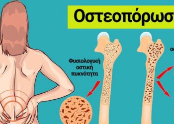 Υγιή οστά: Πώς θα αποφύγετε την οστεοπόρωση μέσω της διατροφής