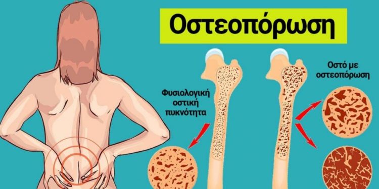 Υγιή οστά: Πώς θα αποφύγετε την οστεοπόρωση μέσω της διατροφής