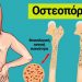 Υγιή οστά: Πώς θα αποφύγετε την οστεοπόρωση μέσω της διατροφής
