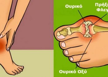 Ουρικό οξύ: Οι αιτίες που ανεβαίνει ΚΑΙ πότε οδηγήσει στην ουρική αρθρίτιδα