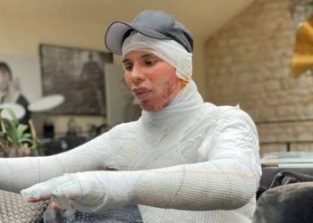 Ο σχεδιαστής του οίκου Balmain σόκαρε τον πλανήτη – Η φωτό που αποκάλυψε το φρικτό ατύχημα