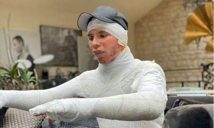 Ο σχεδιαστής του οίκου Balmain σόκαρε τον πλανήτη – Η φωτό που αποκάλυψε το φρικτό ατύχημα