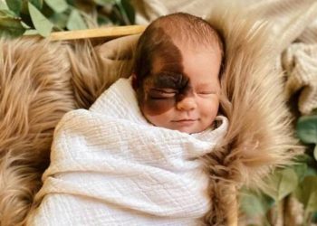 Η μικρή με τον Συγγενή Μελανοκυτταρικό Σπίλο (CMN) που έγινε διάσημη