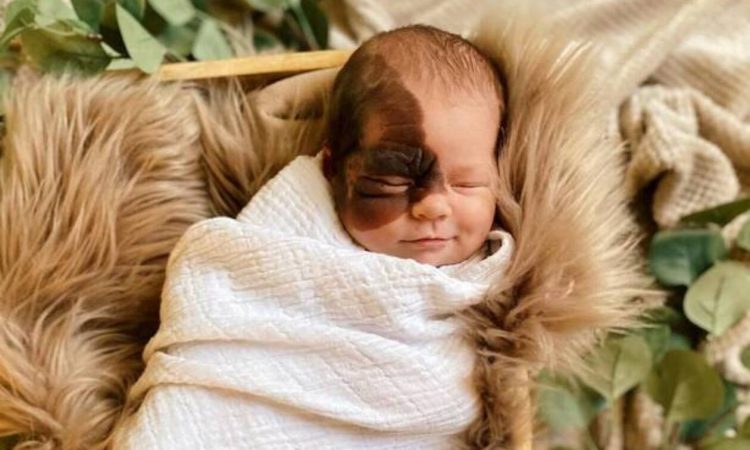 Η μικρή με τον Συγγενή Μελανοκυτταρικό Σπίλο (CMN) που έγινε διάσημη