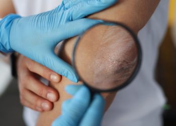 Σκληρόδερμα: Τι είναι, με τι συμπτώματα εκδηλώνεται και τι θεραπεία υπάρχει