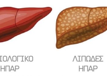 Λιπώδες ήπαρ: 7 προειδοποιητικά συμπτώματα – Βίντεο