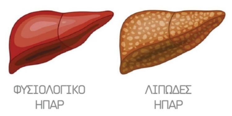 Λιπώδες ήπαρ: 7 προειδοποιητικά συμπτώματα – Βίντεο