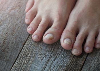 Τι πρέπει να γνωρίζουμε για τους μύκητες στα νύχια. Πως αντιμετωπίζονται
