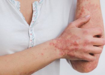 Ψωρίαση: Ποια είναι τα ύποπτα συμπτώματα – Δεν είναι μεταδοτική και Δεν έχει σχέση με την ψώρα