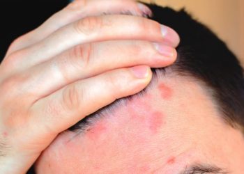 Ατοπική δερματίτιδα στο τριχωτό της κεφαλής: Σε τι διαφέρει από πιτυρίδα και ψωρίαση
