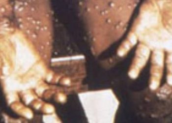 Συναγερμός στη Βρετανία: Φόβοι για εξάπλωση θανατηφόρος παραλλαγής ιλαράς