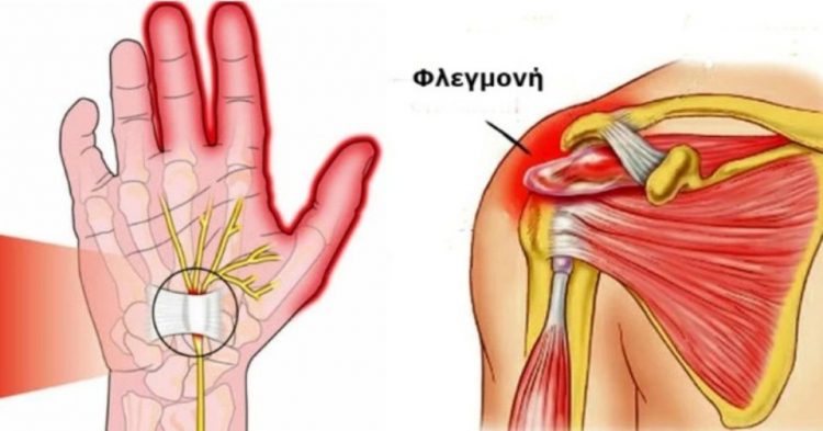 Χρόνια φλεγμονή: Έτσι θα την μειώσετε φυσικά