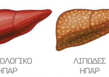 Λιπώδες ήπαρ – Ο σιωπηρός δολοφόνος: Ποιοι κινδυνεύουν περισσότερο