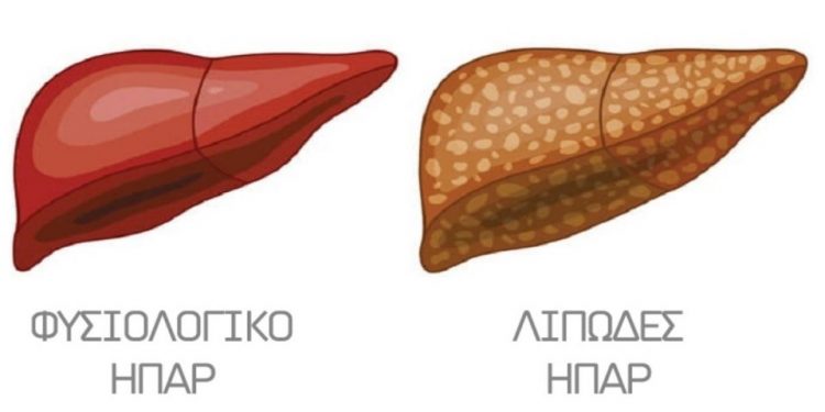 Λιπώδες ήπαρ – Ο σιωπηρός δολοφόνος: Ποιοι κινδυνεύουν περισσότερο