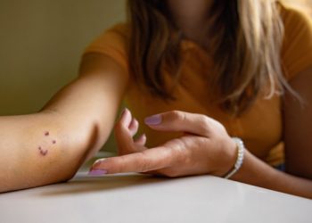 Ξέρετε τι πρέπει να κάνετε για δαγκώματα, τσιμπήματα σε ξηρά και θάλασσα; Οι οδηγίες του ΕΚΑΒ