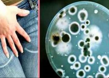 Κολπίτιδα από μύκητα Candida: Τι προκαλεί τις μολύνσεις ζύμης και πώς μπορείτε να απαλλαγείτε από αυτές