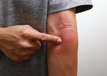 Αν προσέξετε ένα τέτοιο σημάδι στο δέρμα, κάντε εξετάσεις για καρκίνο στο πάγκρεας