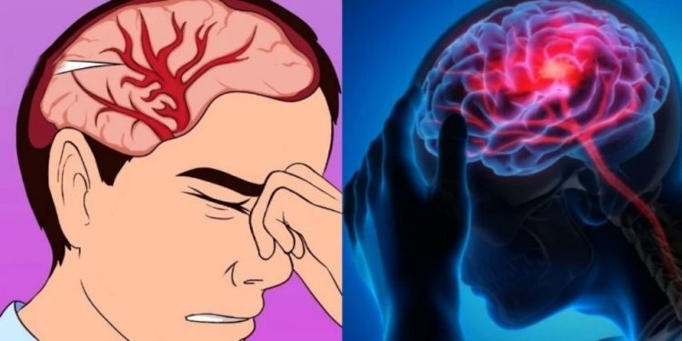 Σιωπηλό εγκεφαλικό: Πώς καταλαβαίνει ο ασθενής – Σε τι διαφέρει το μίνι εγκεφαλικό από το σιωπηλό