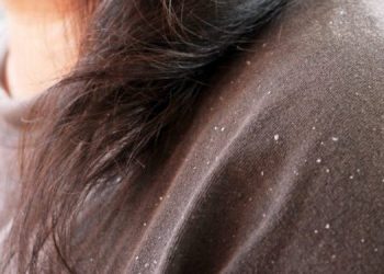 Πώς θα ξέρετε αν έχετε πιτυρίδα ή ξηροδερμία και πώς θα απαλλαγείτε με φυσικούς τρόπους