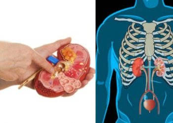 Πέτρα στα νεφρά: 5 tips για να προλάβουμε το πρόβλημα