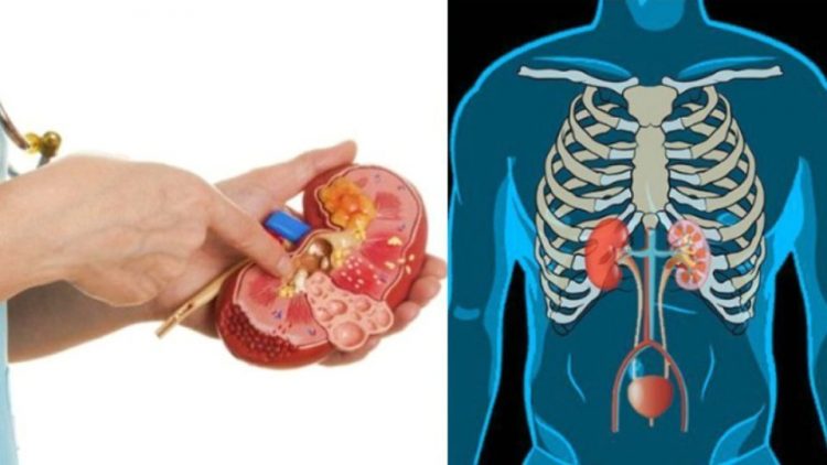 Πέτρα στα νεφρά: 5 tips για να προλάβουμε το πρόβλημα
