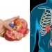 Πέτρα στα νεφρά: 5 tips για να προλάβουμε το πρόβλημα