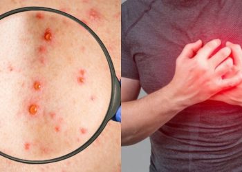 Πρόσφατη μόλυνση από έρπητα ζωστήρα αυξάνει τον κίνδυνο εμφράγματος